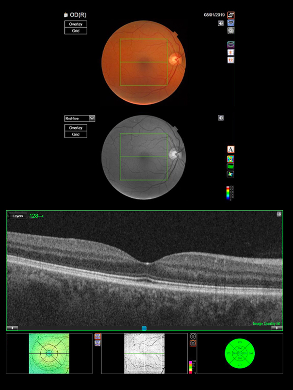 oct eye test norwich